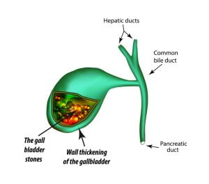 Inflammation of the gallbladder