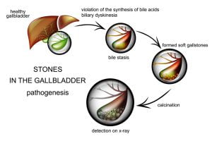 Illustration of gallstone disease