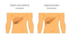 Cholecystectomy