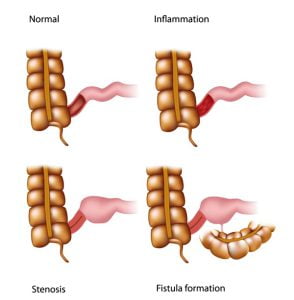 Crohns ileitis