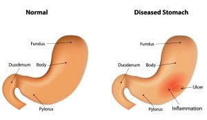 Normal stomach and diseased stomach