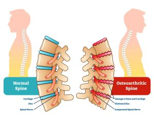 Spine osteoarthritis