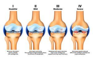 Stages of knee Osteoarthritis