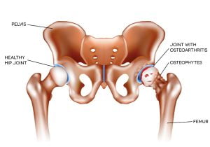 Arthritis of the hip joint