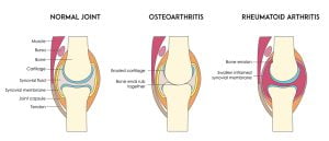 Types of arthritis