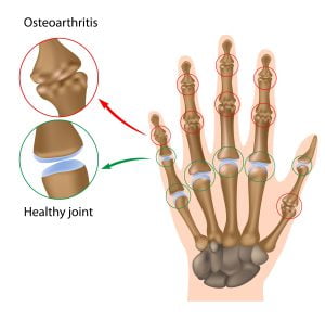 Osteoarthritis of the hand