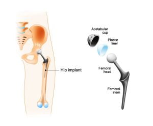 Total hip replacement (arthroplasty) and hip Implant