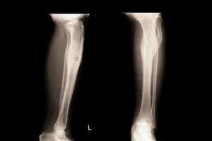 Xray image for osteomyelitis
