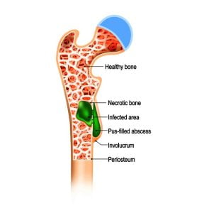Osteomyelitis