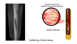 Osteomyelitis Causes