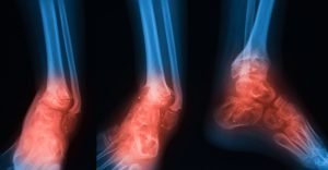 X-ray image of ankle joint with osteomyelitis