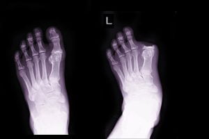 X-ray image before and after osteomylitis operation