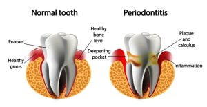 Periodontitis