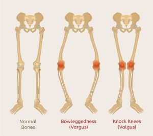 Rickets types