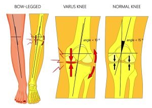 Different types of deformities