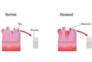 What You Should Know About Irritable Bowel Syndrome?