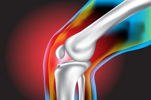 Osteoarthritis