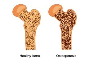 What You Should Know About Osteoporosis