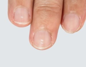 Hypocalcemia symptoms