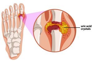 Gout in foot