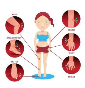 Gout disease