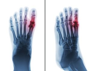Film X ray of human foot with gout