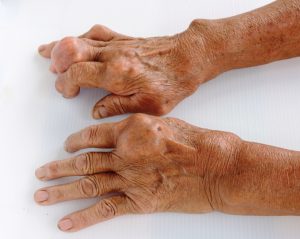 Fingers of a patient with gout