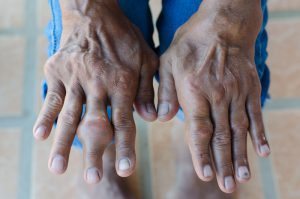 Gout in fingers