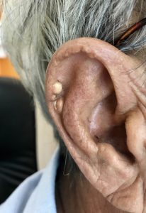 Tophi at the helix of ear (patient had poor control hyperuricemia)