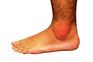 Image of painful gout inflammation on ankle joint