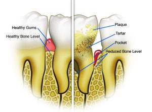 Healthy teeth and teeth with periodontal disease