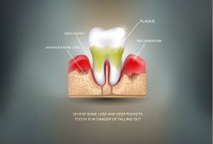 Periodontitis - Inflammation of the gums detailed illustration