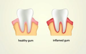 Illustration of gingivitis