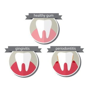 Human gum inflammation