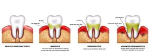 Periodontitis and inflammation of the gums