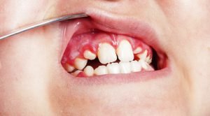Stomatitis and gingivitis in a child