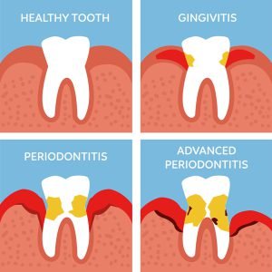 Different stages of periodental disease
