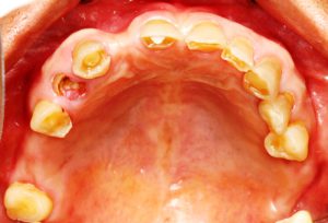 The loosen teeth in elderly