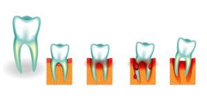 Illustration of tooth loss