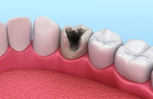 Teeth with caries