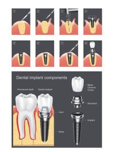 Dental implant