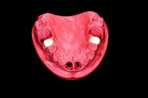 Tooth loss illustration