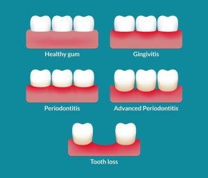 Stages of periodontal disease