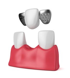 3D illustration of teeth with dental maryland bridge in gums