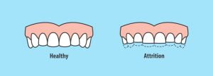 Effects of tooth grinding (bruxism)