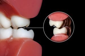 Dental occlusion molars teeth