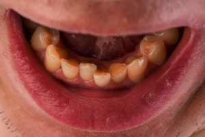 Malocclusion