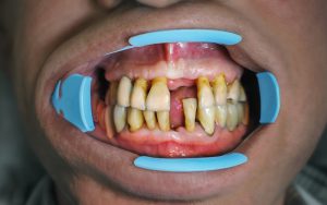 Teeth sensitivity causes