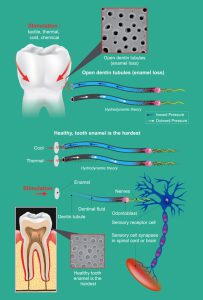 Sensitive teeth causes (enamel loss)