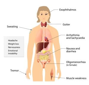 Symptoms of Graves' disease